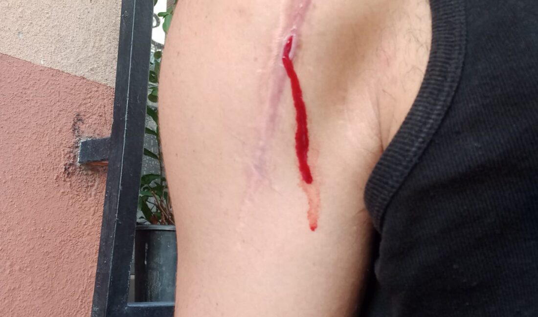 Omuzunda protez olan Engin Y. , doktorunun takılan parçanın ufak