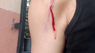 Omuzunda protez olan Engin Y. , doktorunun takılan parçanın ufak