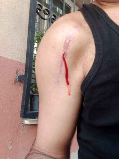 Omuzunda protez olan Engin Y. , doktorunun takılan parçanın ufak