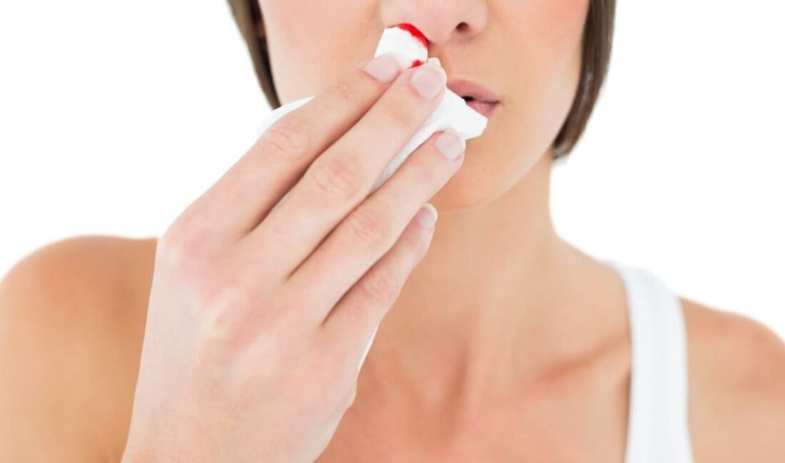 Burun kanaması, halk arasında sıkça karşılaşılan ve genellikle endişe yaratmayan