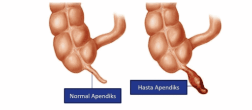 ÇOCUKLARDA APANDİSİTİN TANI VE TEDAVİSİ