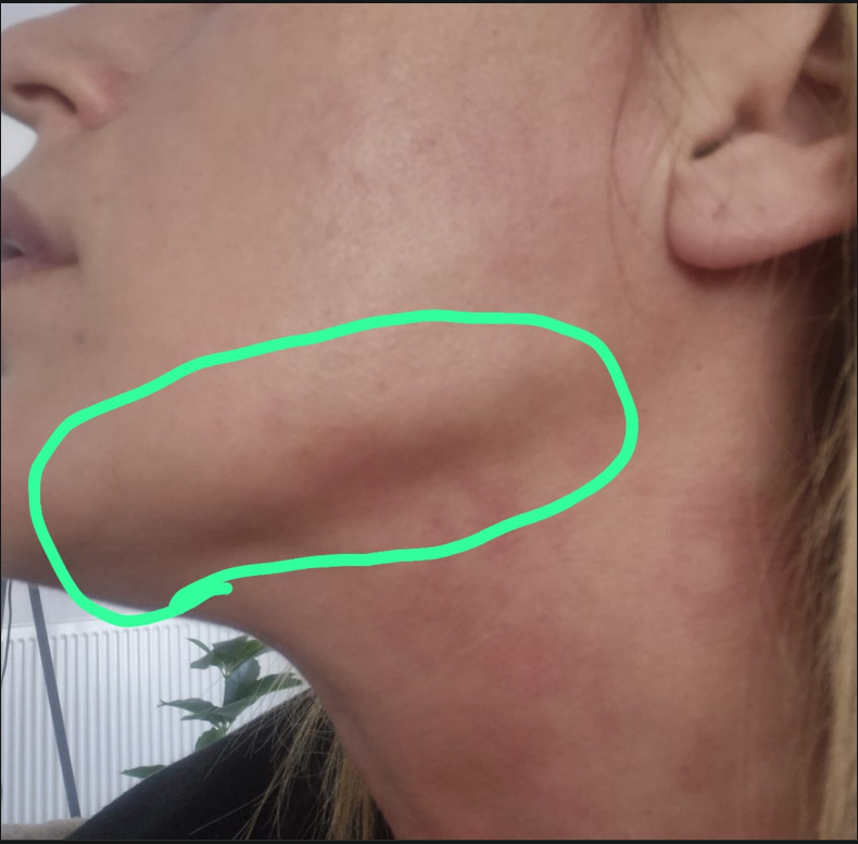 Estelift klinik iddialar