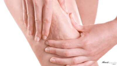 Prof. Dr. Ahmet Karacalar, selülitin estetik bir kusurdan ziyade metabolik