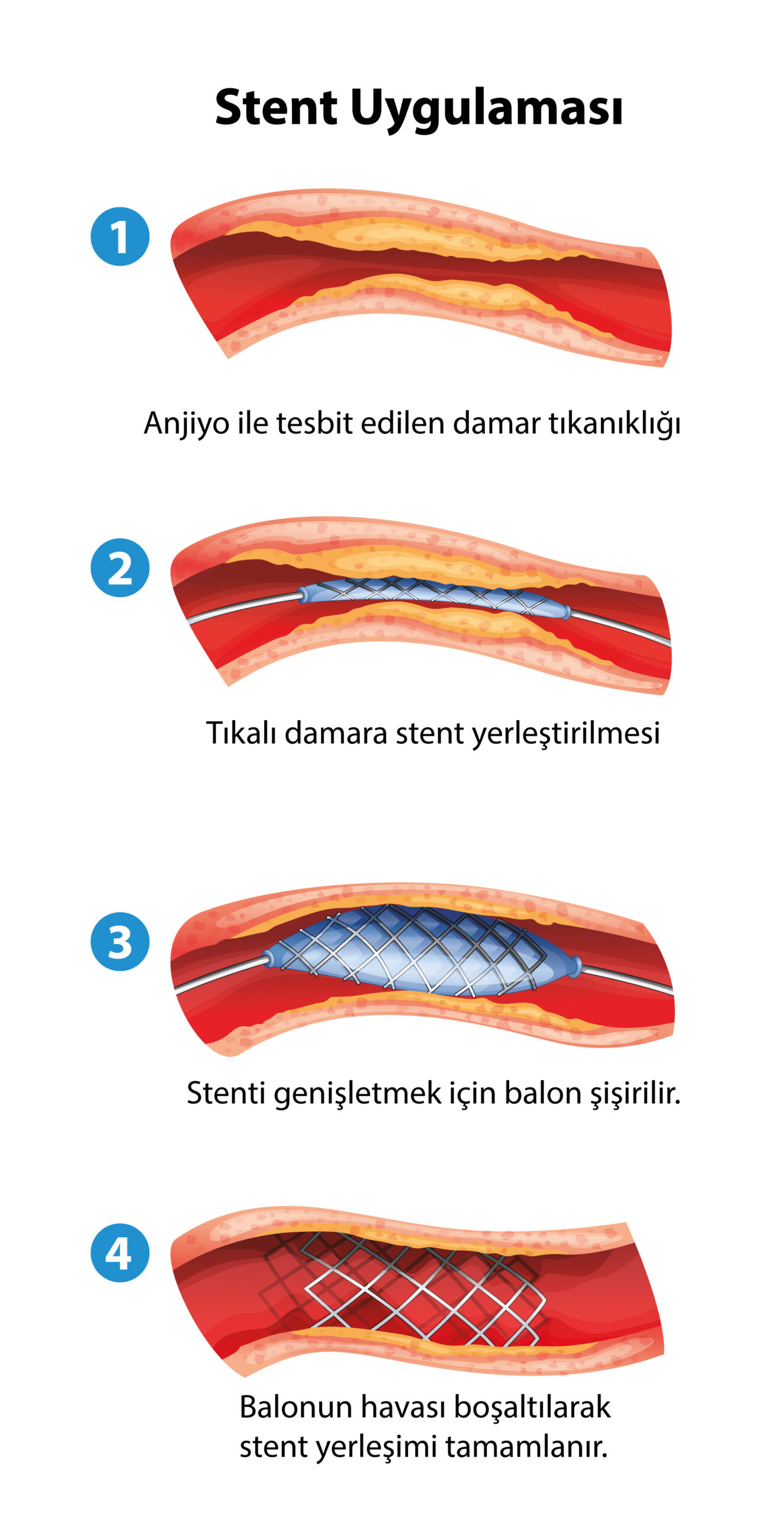 Bazekol Hastanesi'nde Koroner ve Sanal Anjiyo ile Erken Teşhis ve Tedavi